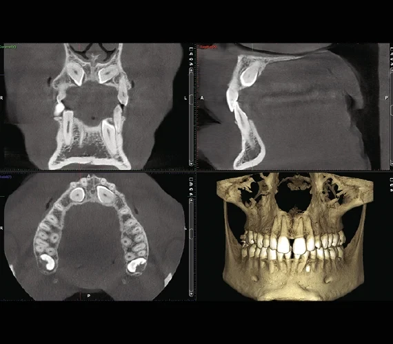 Exemple d’imagerie cone beam : trois vues en coupe et une reconstruction 3D des mâchoires.