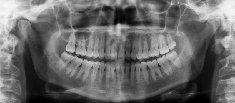 Exemple de radiographie panoramique montrant les dents et les deux mâchoires sur une seule image.