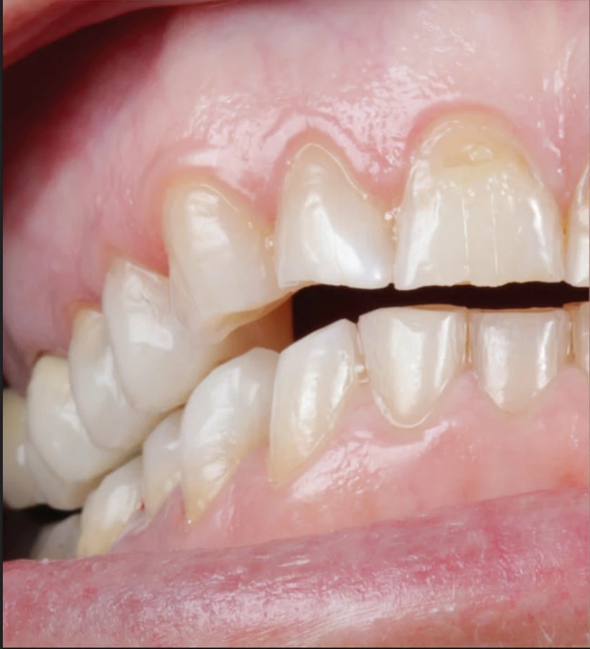 Vue de profil après reconstruction des dents du fond, les dents de devant ne se touchent pas