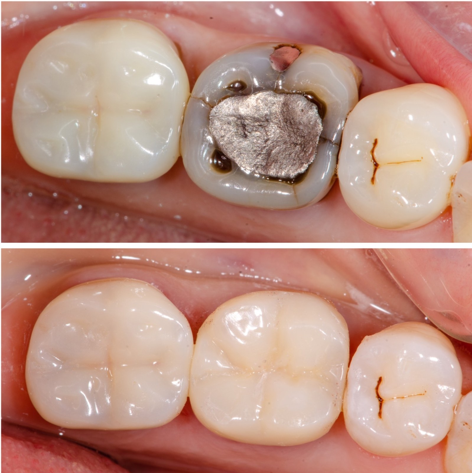 En haut, un amalgame entouré de fissures et de caries ; en bas, la même dent restaurée par un onlay en céramique