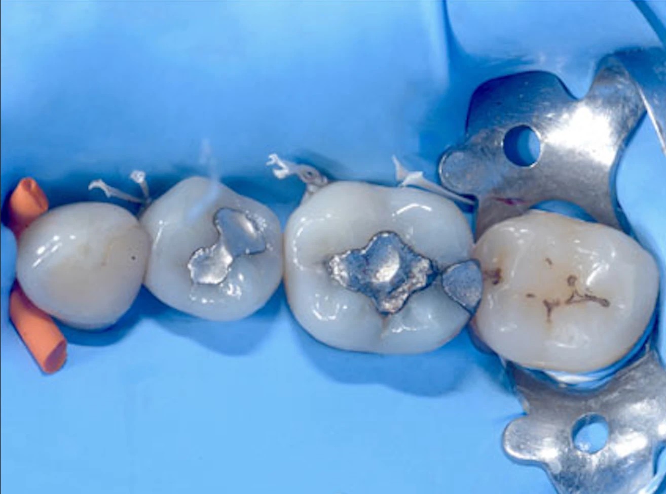 Dents porteuses d’amalgames isolées par une digue avant leur retrait
