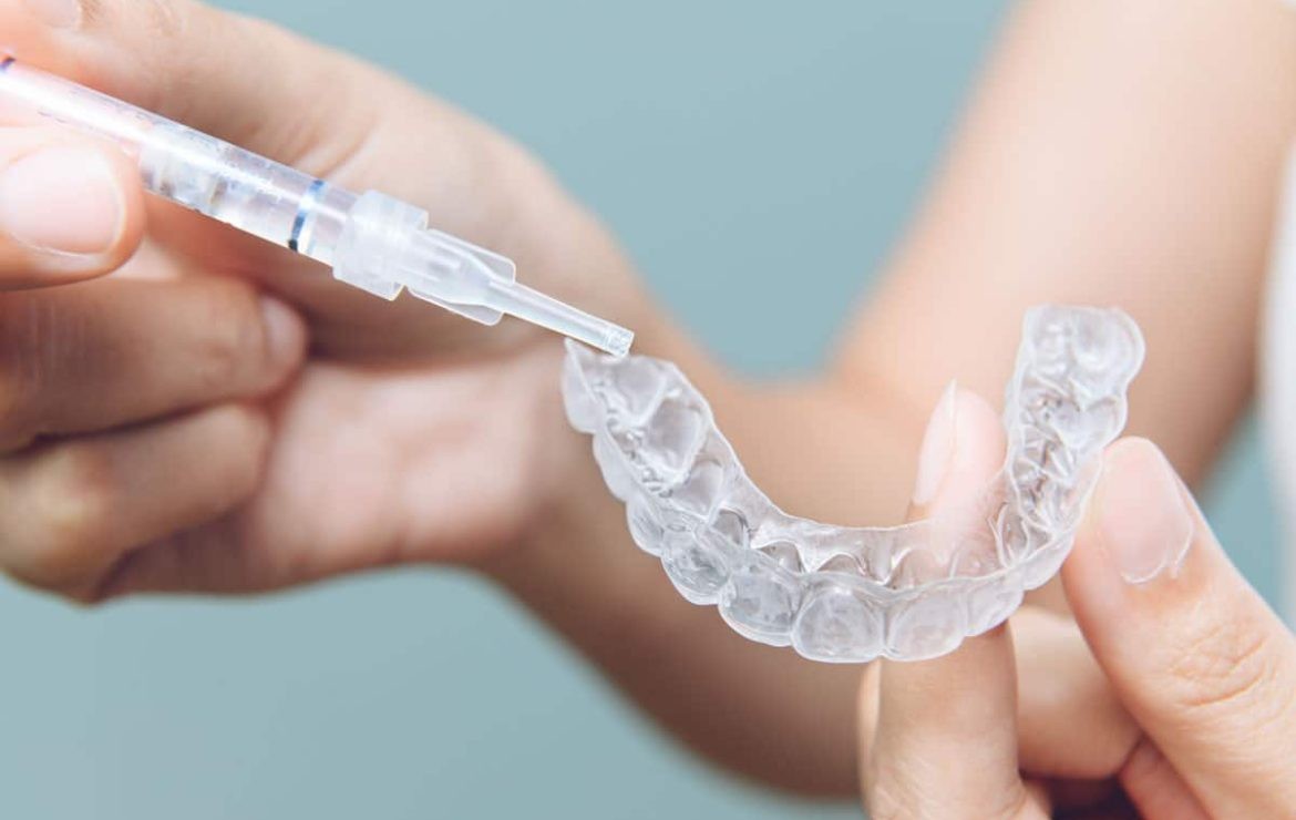 Application du gel de blanchiment dans une gouttière transparente sur mesure