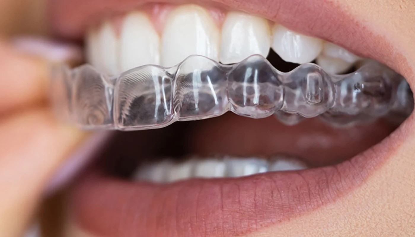 Gouttière transparente de blanchiment portée sur les dents du haut