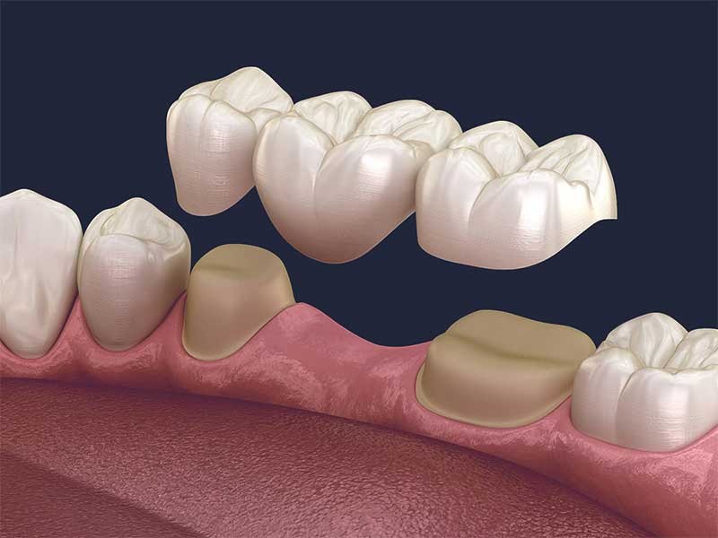 Illustration d’un bridge de trois éléments au-dessus de deux dents préparées encadrant une dent absente