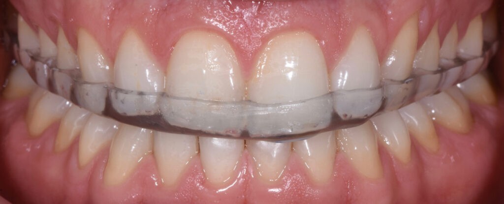 Gouttière occlusale transparente portée sur les dents du haut