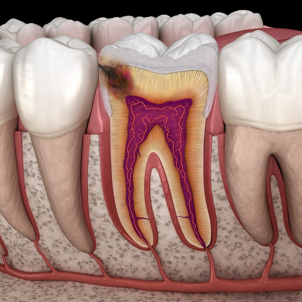 Coupe d’une molaire montrant une carie qui a traversé l’émail et progresse dans la dentine vers le nerf