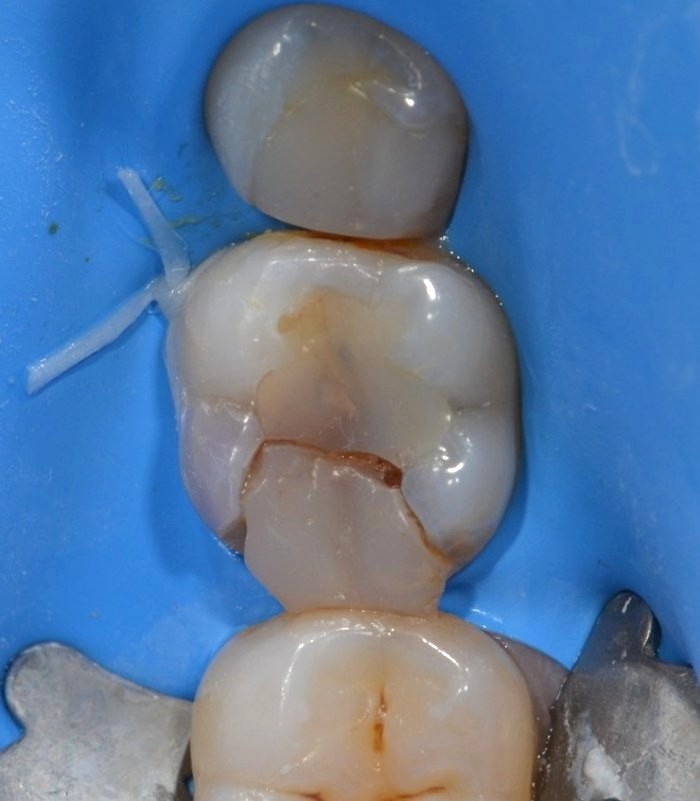 Étape 1 : ancienne restauration fracturée sur une molaire, sous digue