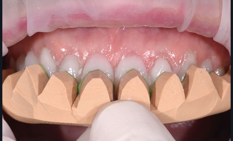 Clé de contrôle posée sur les dents préparées, issue du projet de sourire