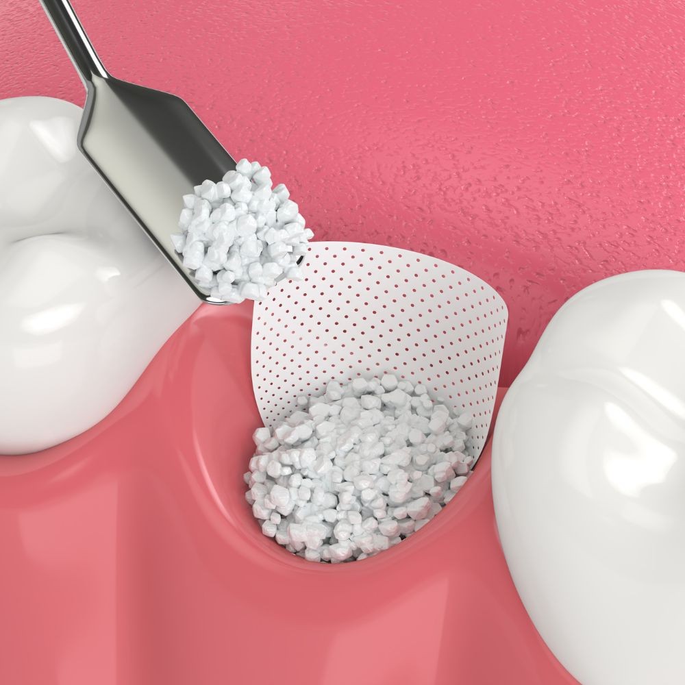 Illustration d’un substitut osseux en granules déposé dans une alvéole, protégé par une membrane