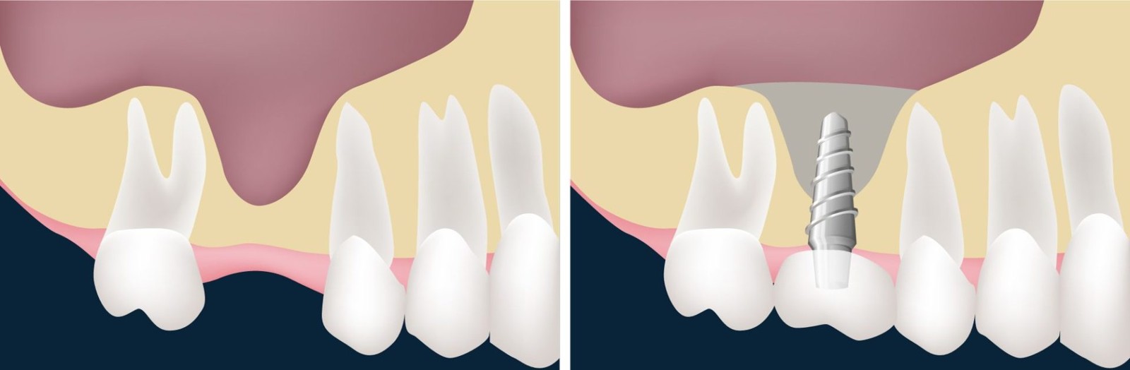 À gauche, le sinus descendu au-dessus d’une dent manquante ; à droite, le substitut osseux placé sous le sinus et l’implant en place