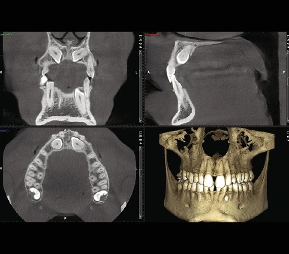 Scanner 3D cone beam : coupes de la mâchoire et reconstruction en trois dimensions