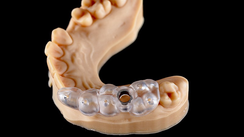 Guide chirurgical transparent posé sur un modèle de mâchoire, avec l’anneau qui guide la pose de l’implant