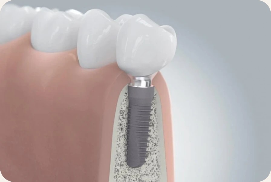 Illustration d’un implant dans l’os de la mâchoire, avec son pilier et sa couronne