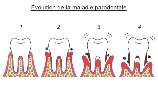 Quatre schémas montrant l’évolution de la maladie parodontale, de la gencive saine à la perte d’os et à la mobilité de la dent