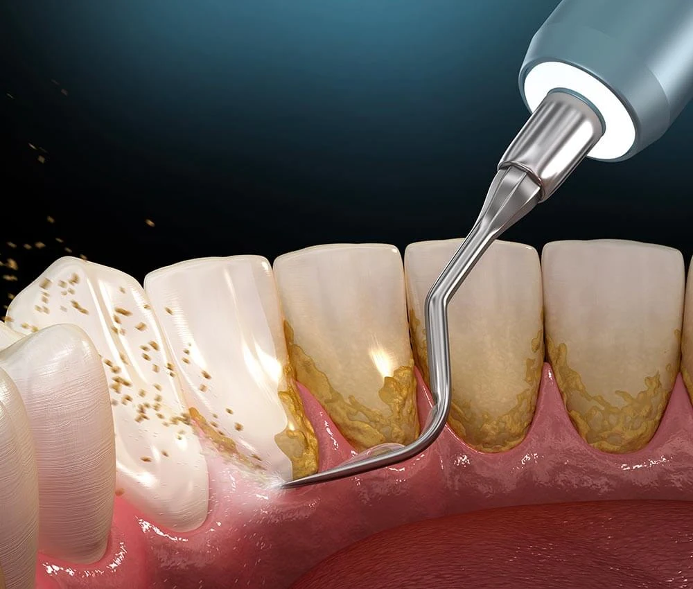 Illustration du nettoyage du tartre sur les dents et les racines.