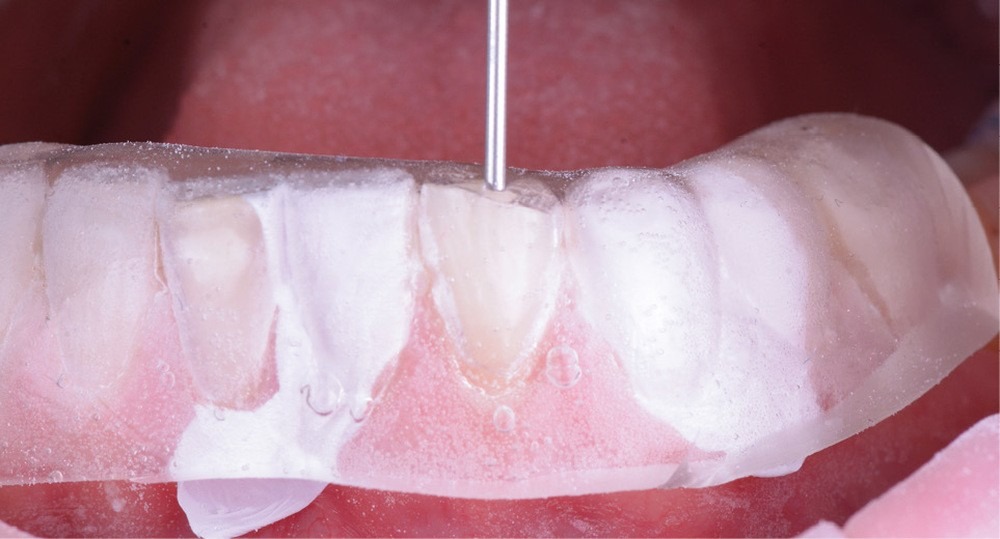 La clé transparente posée sur les dents : la résine composite est injectée dent par dent par un petit orifice, pour reproduire fidèlement la forme du projet.