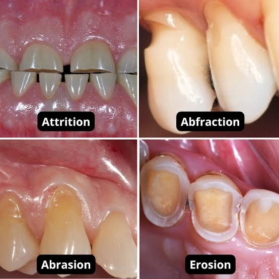 Les quatre types d’usure : attrition (bruxisme), abfraction, abrasion et érosion.